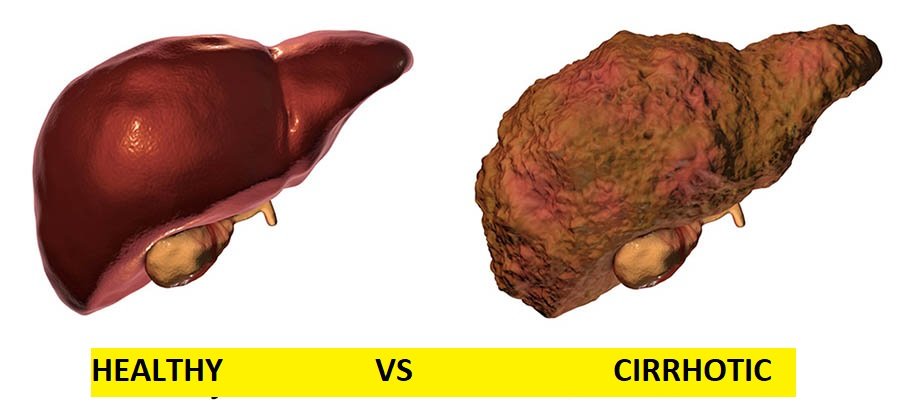 cirrhosis of the liver symptoms