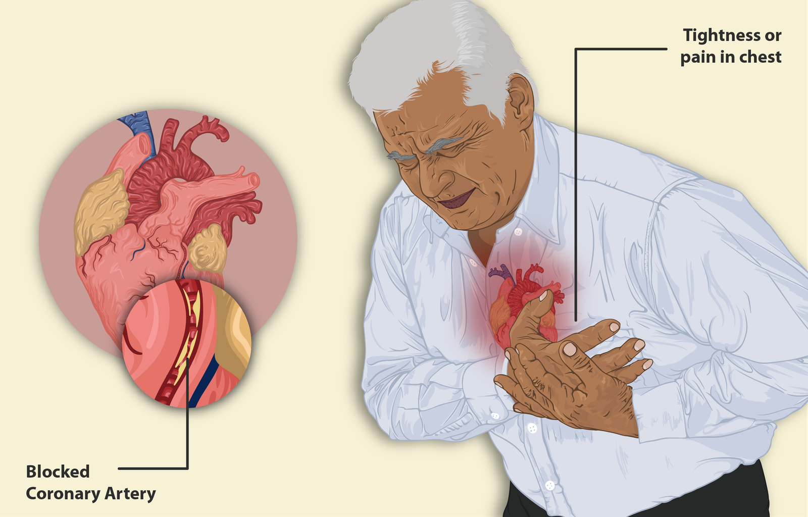 Heart Attack Symptoms, Causes, And Treatment